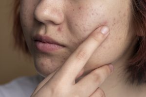 Zinc, Bahan Obat untuk Mengatasi Jerawat dan Menyeimbangkan Kadar Minyak pada Kulit