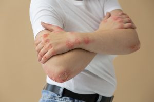 Penelitian: Penggunaan Biotin dalam Pengobatan Sclerosis Ganda