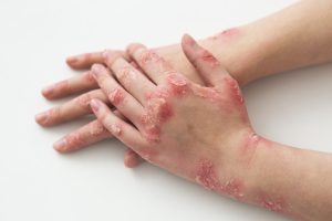 Kekurangan Biotin Dapat Memengaruhi Kesehatan Rambut dan Kuku